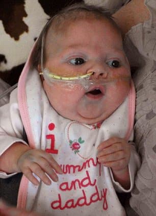 Morning Feeding: Baby Girl Becomes Youngest Person To Have Liver Transplant