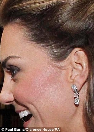 Kate Middleton Has A Childhood Scar She’s Not Willing To Talk About