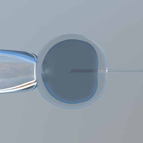 Using One Embryo In IVF Doesn’t Diminish Chances Of Conception