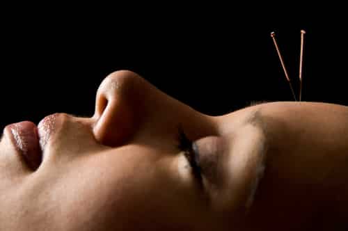 Morning Feeding: Acupuncture Generally Safe For Children, Says Study