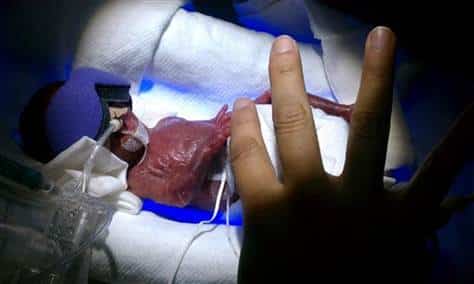 One Of World’s Smallest Babies Ever Born Scheduled To Go Home By New Year’s