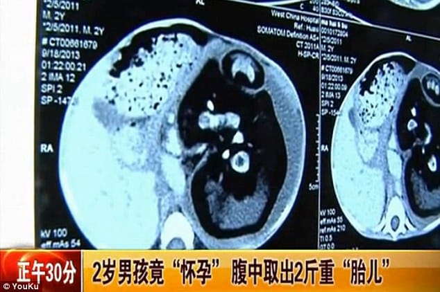 This Poor Boy Had A Parasitic Twin Growing Inside His Stomach So Doctors Diagnosed Him ‘Pregnant’