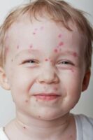 chicken pox vaccine after effects