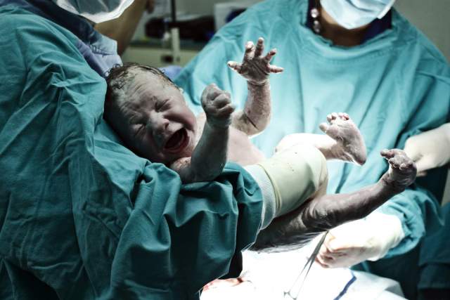 Women Scoops Out Her Own Twins During A C-Section And I Just Can’t With This Right Now