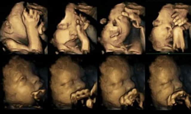 Disturbing Ultrasound Pictures Show How Unborn Babies React To Their Smoking Moms