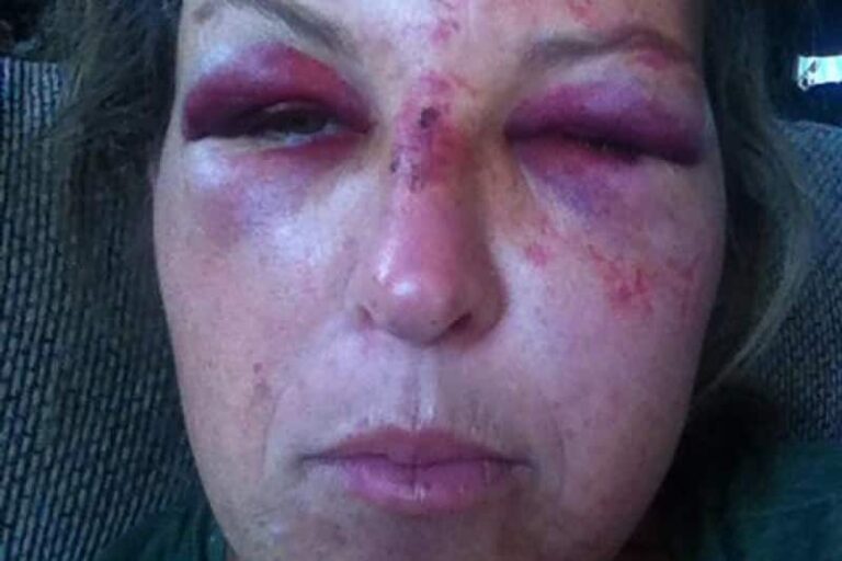 Heroic Daycare Worker Assaulted in Line of Duty for Protecting Her Charges From a Drunk, Violent Father