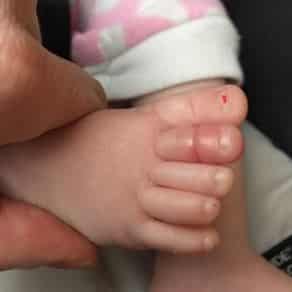 A Strand of Long Hair Can Become a ‘Tourniquet’ Around a Baby’s Toes