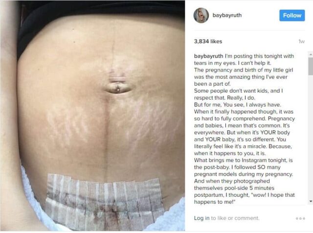 Instagram Influencer Shares Photo with Postpartum Stretch Marks