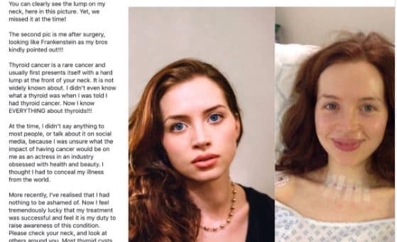 Woman’s Viral Photo Shows Thyroid Cancer Symptom She Completely Missed