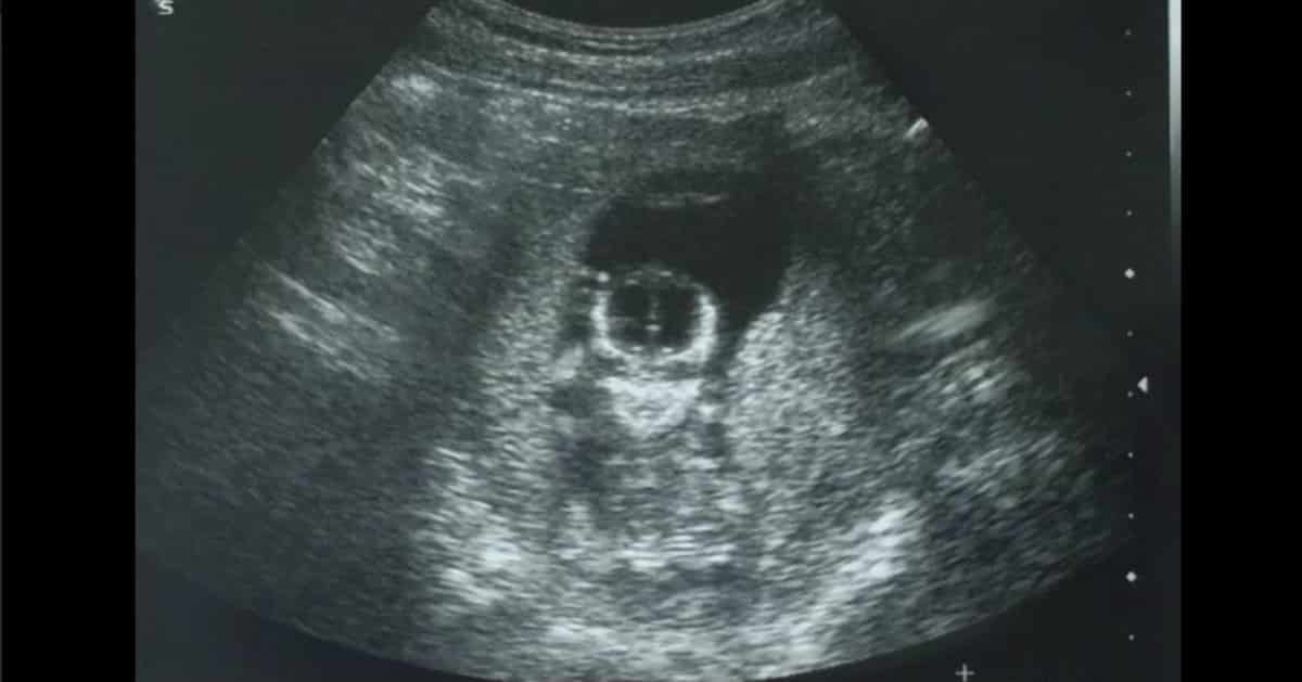 Baby Ultrasound looks like Frieza