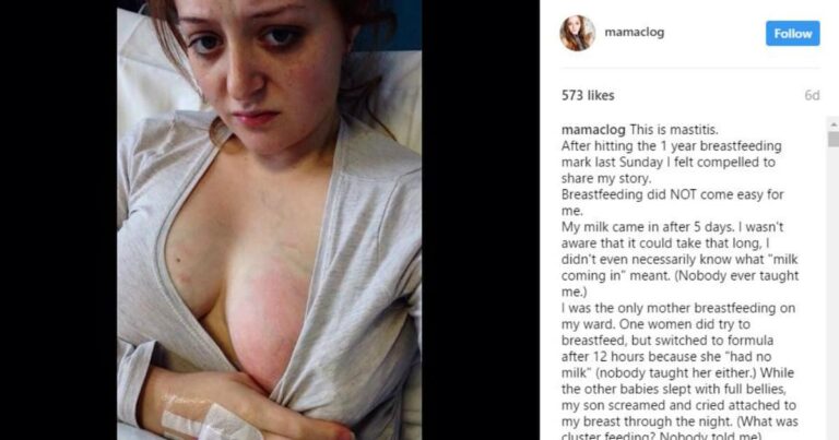 ‘This Is Mastitis,’ Painful Photo Shows What Hard Work Breastfeeding Really Is