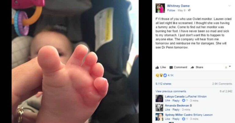 Mom Posts Facebook Warning After Owlet Monitor Leaves Blister on Baby’s Foot