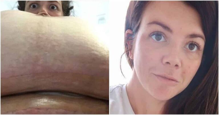 Mom’s Photo of Her Postpartum C-Section Tummy Is Real AF and We are Here for It