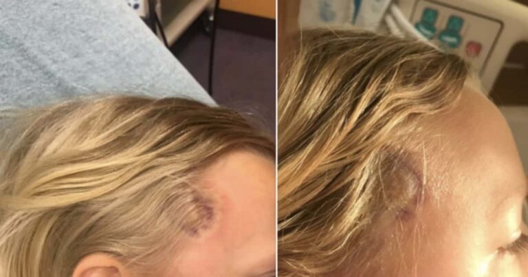 A Girl’s Rare Reaction to a Tick Bite Will Make You Want to Stay Indoors