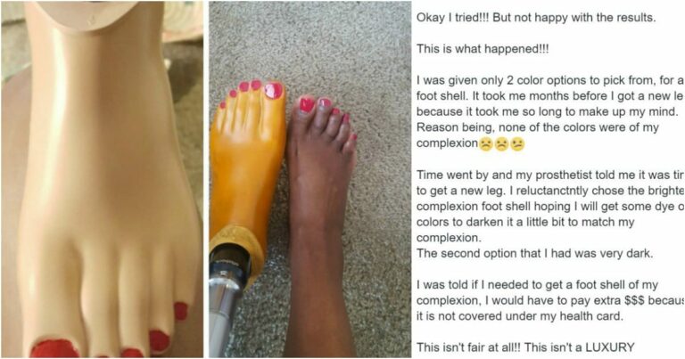 Mom Shares Her Frustration Over Trying to Find a Prosthetic That Matches Her Skin Tone