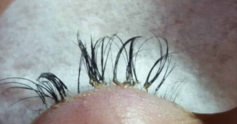 These Gruesome Photos Will Make You Rethink Eyelash Extensions
