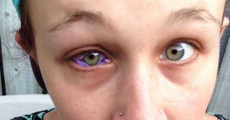 This Woman’s Botched Sclera Tattoo Is a PSA on Why You Should Never Tattoo Your Eyeball