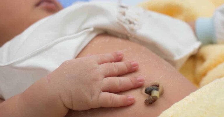 Delaying Cord Clamping by Even a Minute Could Help Save Premature Babies