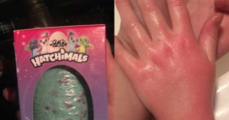 Mom Shares Urgent Hatchimals Warning After Her Girl Suffers Chemical Burns