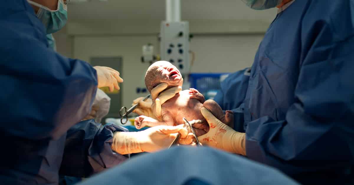 c-section babies